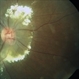 Idiopathic Retinal Vasculitis, Aneurysms, and Neuroretinitis (IRVAN) Idiopathic Retinal Vasculitis, Aneurysms, and Neuroretinitis (IRVAN)