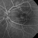 Idiopathic Retinal Vasculitis, Aneurysms, and Neuroretinitis (IRVAN) Idiopathic Retinal Vasculitis, Aneurysms, and Neuroretinitis (IRVAN)