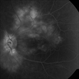 Idiopathic Retinal Vasculitis, Aneurysms, and Neuroretinitis (IRVAN) Idiopathic Retinal Vasculitis, Aneurysms, and Neuroretinitis (IRVAN)