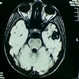 Cavernous Hemangioma of the Retina Cavernous Hemangioma of the Retina