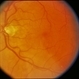 CNVM - Subfoveal, Non-Treated CNVM - Subfoveal, Non-Treated