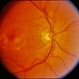 CNVM - Subfoveal, Non-Treated CNVM - Subfoveal, Non-Treated