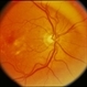 CNVM - Subfoveal, Non-Treated CNVM - Subfoveal, Non-Treated