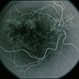 CNVM - Subfoveal, Non-Treated CNVM - Subfoveal, Non-Treated