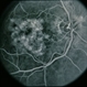 CNVM - Subfoveal, Non-Treated CNVM - Subfoveal, Non-Treated