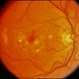 CNVM - Subfoveal, Non-Treated CNVM - Subfoveal, Non-Treated