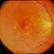 CNVM - Subfoveal, Non-Treated CNVM - Subfoveal, Non-Treated