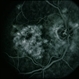 CNVM - Subfoveal, Non-Treated CNVM - Subfoveal, Non-Treated
