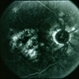 CNVM - Subfoveal, Non-Treated CNVM - Subfoveal, Non-Treated