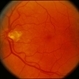 CNVM - Subfoveal, Non-Treated