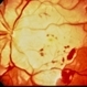 Purtscher's  Retinopathy Purtscher's  Retinopathy