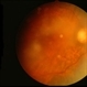 Orbital Lymphoma Orbital Lymphoma