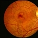 CNVM - Idiopathic Treated
