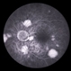 Pneumocystis Carinii Choroiditis / HIV Pneumocystis Carinii Choroiditis / HIV