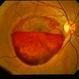 Sub ILM Hemorrhage / CPR Sub ILM Hemorrhage / CPR