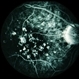 Grouped Albinotic Spots in Macula Grouped Albinotic Spots in Macula