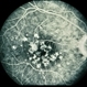 Grouped Albinotic Spots in Macula Grouped Albinotic Spots in Macula
