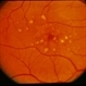 Grouped Albinotic Spots in Macula Grouped Albinotic Spots in Macula