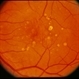 Grouped Albinotic Spots in Macula Grouped Albinotic Spots in Macula