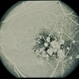 Grouped Albinotic Spots in Macula Grouped Albinotic Spots in Macula
