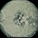 Grouped Albinotic Spots in Macula Grouped Albinotic Spots in Macula