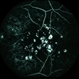 Grouped Albinotic Spots in Macula Grouped Albinotic Spots in Macula
