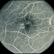 Acquired Parafoveal Telangiectasis