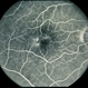 Acquired Parafoveal Telangiectasis Acquired Parafoveal Telangiectasis