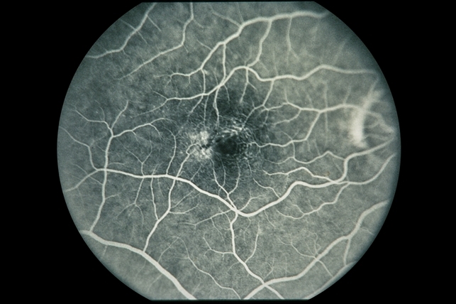 Parafoveal deposits telangiectasis crystaline file imagebank Acquired Parafoveal Telangiectasis - Retina Image Bank
