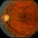 Hypotony from Over-Filtration Hypotony from Over-Filtration