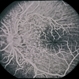 Hypotony from Over-Filtration Hypotony from Over-Filtration