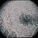 Hypotony from Over-Filtration Hypotony from Over-Filtration