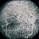Hypotony from Over-Filtration Hypotony from Over-Filtration