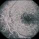 Hypotony from Over-Filtration Hypotony from Over-Filtration