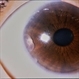 Metastatic Breast Cancer / Iris & Choroid Metastatic Breast Cancer / Iris & Choroid