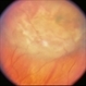 Carcinoid in the Choroid