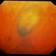 Sudden Central Scotoma