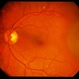 Choroidal Nevus With CNVM / Pseudo-MM