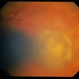 Choroidal Nevus With CNVM / Pseudo-MM