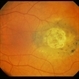 Nevus With Calcific Scar Nevus With Calcific Scar