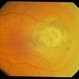 Nevus With Calcific Scar Nevus With Calcific Scar