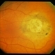 Nevus With Calcific Scar Nevus With Calcific Scar