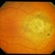 Nevus With Calcific Scar Nevus With Calcific Scar