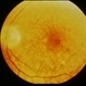 Oxalosis / Methoxyflurane Oxalosis / Methoxyflurane