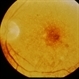 Oxalosis / Methoxyflurane Oxalosis / Methoxyflurane