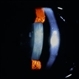 Chalcosis