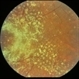 Tamoxifen Toxicity Tamoxifen Toxicity