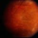 Diffues Unilateral Subacute Neuroretinitis DUSN Diffues Unilateral Subacute Neuroretinitis DUSN