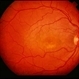Reticular Pattern Dystrophy Reticular Pattern Dystrophy