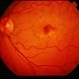 Reticular Pattern Dystrophy Reticular Pattern Dystrophy